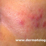 rosacea2