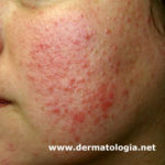 rosacea5