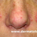 rosacea6