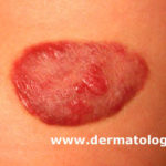 hemangioma3