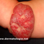 hemangioma5