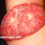 hemangioma6