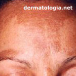 melasma2