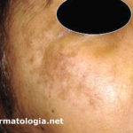 melasma3