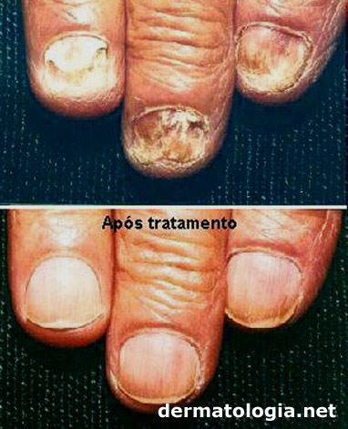 micose das unhas