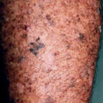 xeroderma