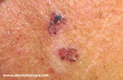 carcinomas basocelulares