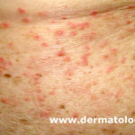 Dermatose acantolítica transitória