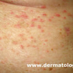 Dermatose acantolítica transitória