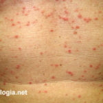 Dermatose acantolítica transitória