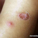 impetigo2