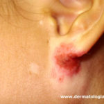 impetigo3