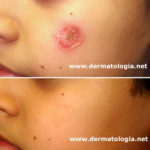 impetigo5