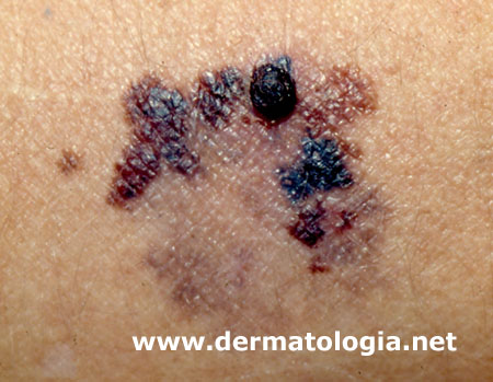 linfadenectomia melanoma