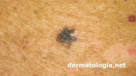 diagnóstico do melanoma