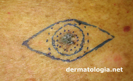 cirurgia do melanoma