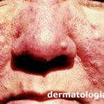 rosacea