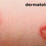 dermatofitose