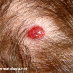 hemangioma infantil