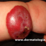 hemangioma infantil