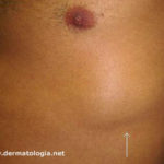 lipoma