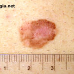 melanoma2