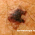 melanoma