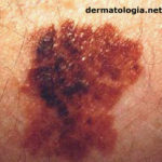 melanoma