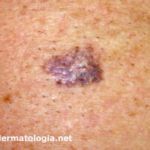 melanomainsitu2