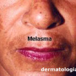 melasma