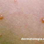 molusco contagioso