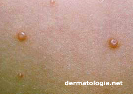 molusco contagioso