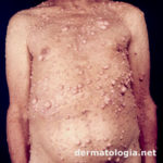 neurofibromatose